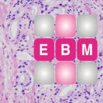 Prostatakarzinom als Schnitt unter dem Mikroskop. Im Vordergrund: "EBM"-Logo